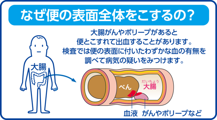 なぜ便の表面全体をこするのか？大腸がんやポリープがあると便とこすれて出血することがあります。検査では便の表面に付いたわずかな血の有無を調べて病気の疑いをみつけます。